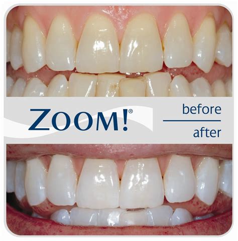 zoom teeth whitening in mirdif